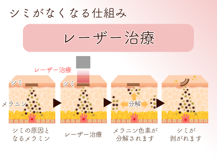 シミがなくなる仕組み