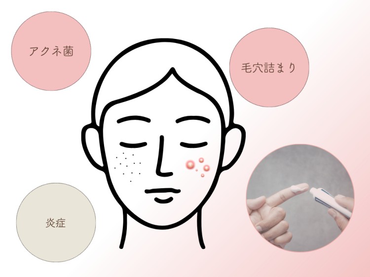 ニキビ治療