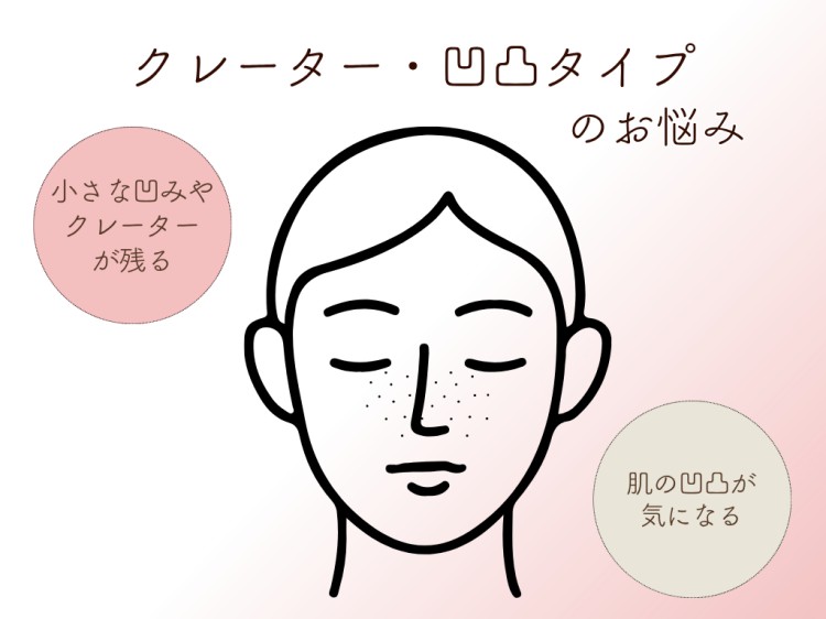 クレーター・凹凸タイプのお悩み
