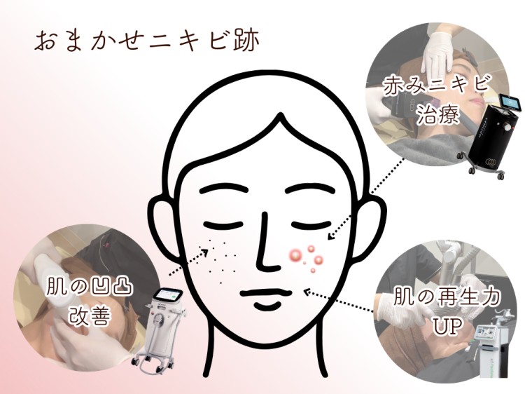 おまかせニキビ跡