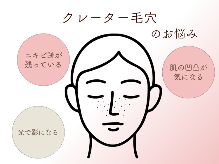 クレーター毛穴のお悩み