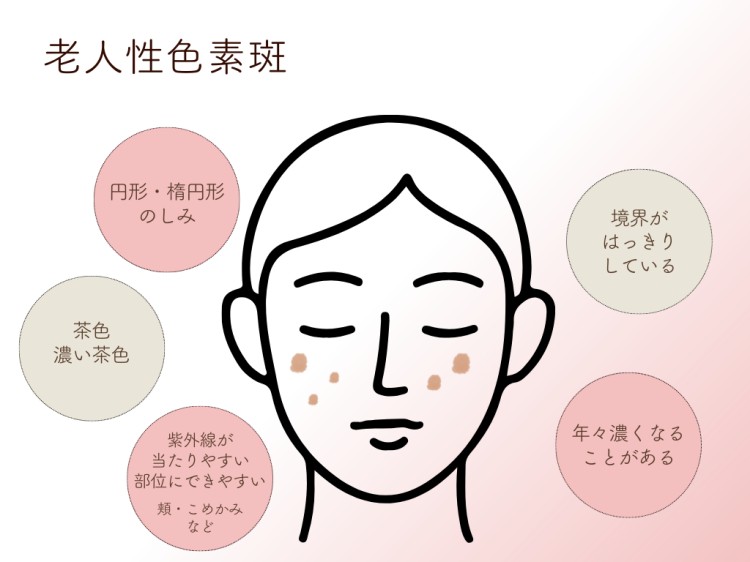 老人性色素斑