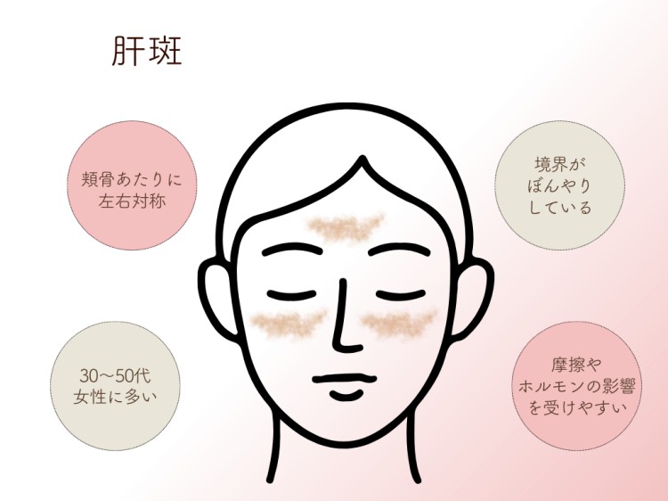 肝斑