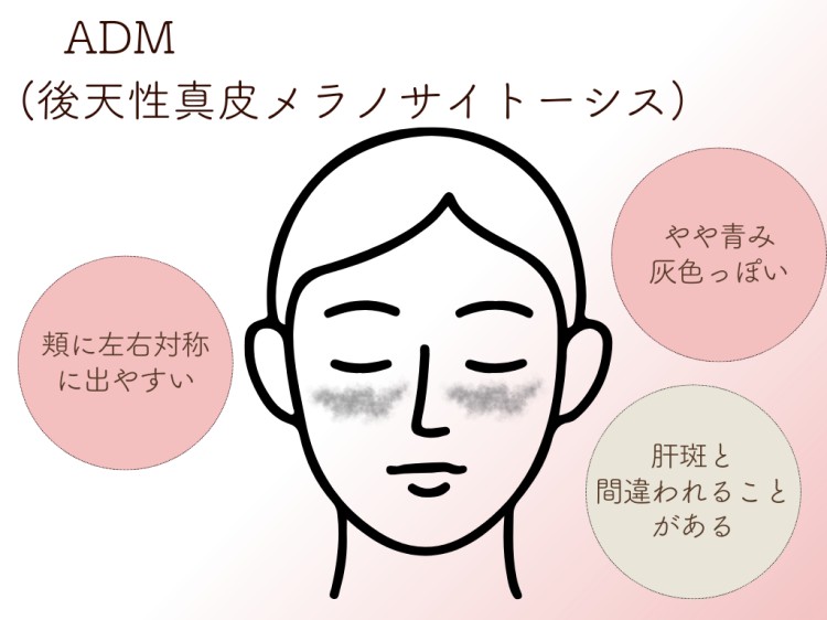 ADM
