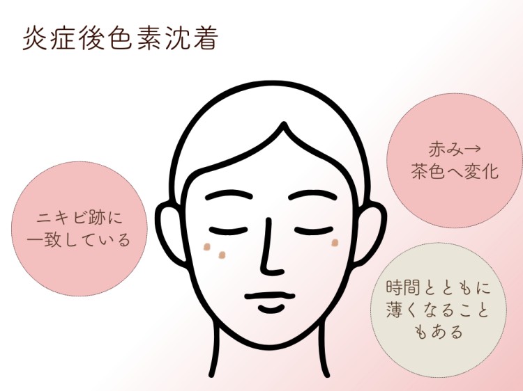 炎症後色素沈着