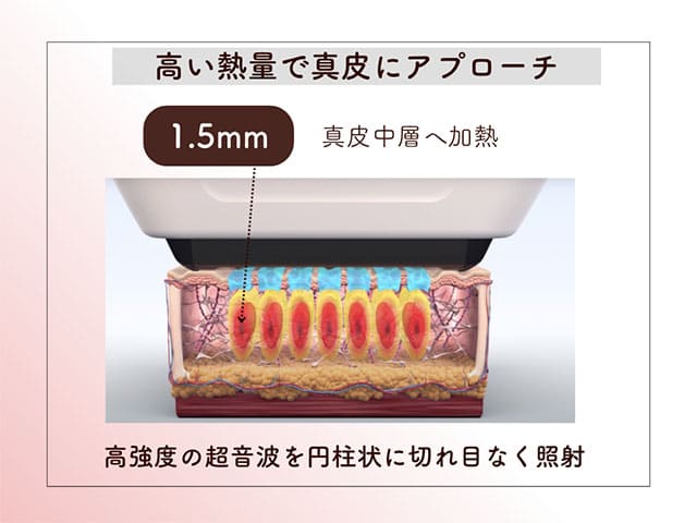 高い熱量で真皮にアプローチ