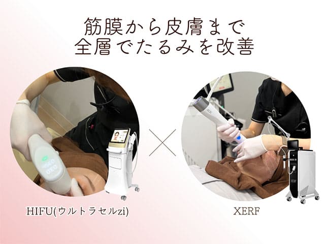 筋膜から皮膚まで全層でたるみを改善