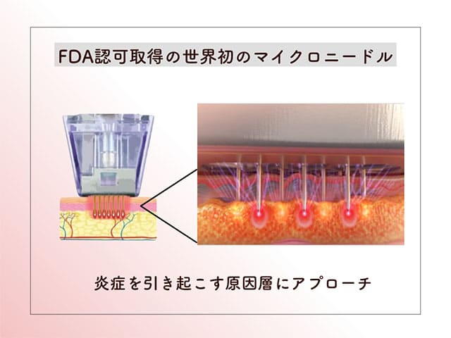FDA認可取得の世界初のマイクロニードル