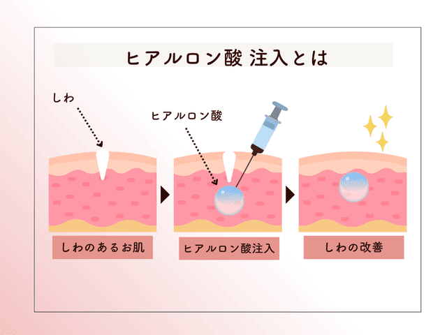 ヒアルロン酸注入とは