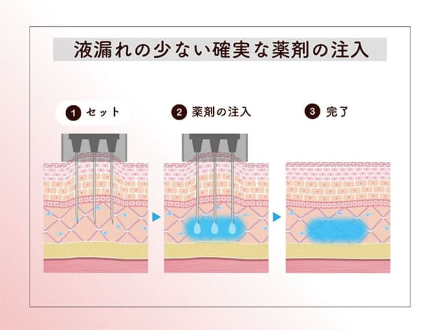 液漏れの少ない確実な薬剤の注入