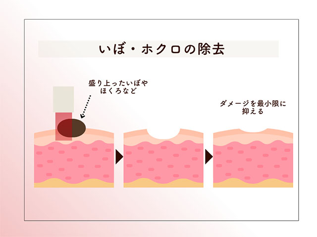 いぼ・ホクロの除去