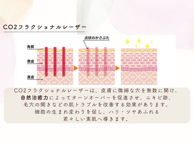 CO2フラクショナルレーザー
