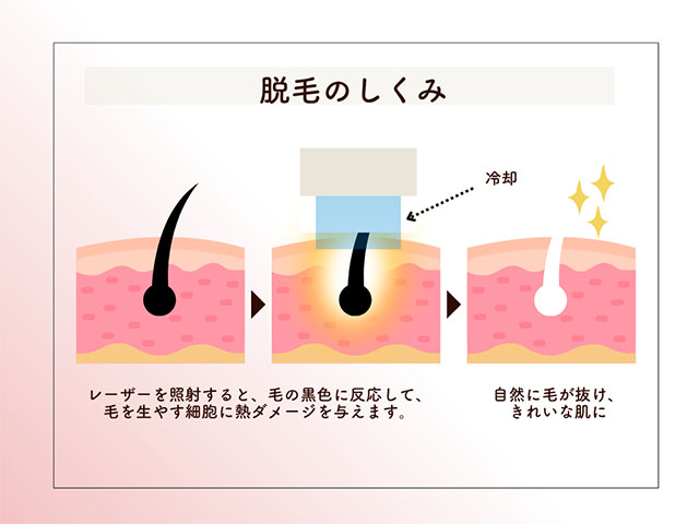 脱毛のしくみ