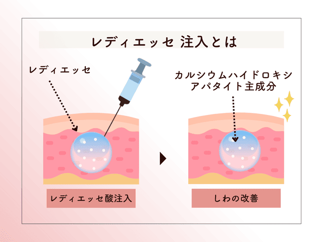 レディエッセ注入とは