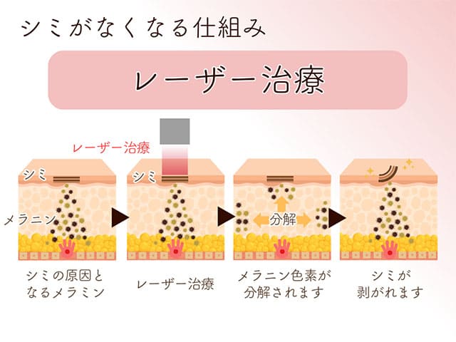 シミがなくなる仕組み