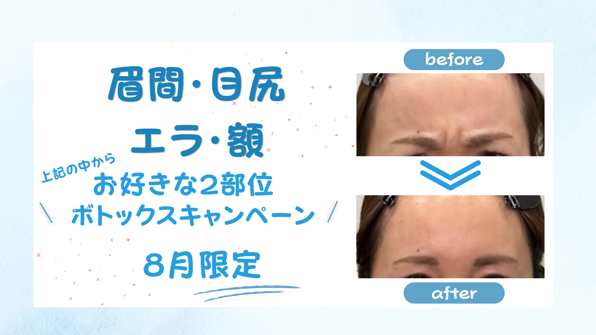 ボトックスキャンペーン
