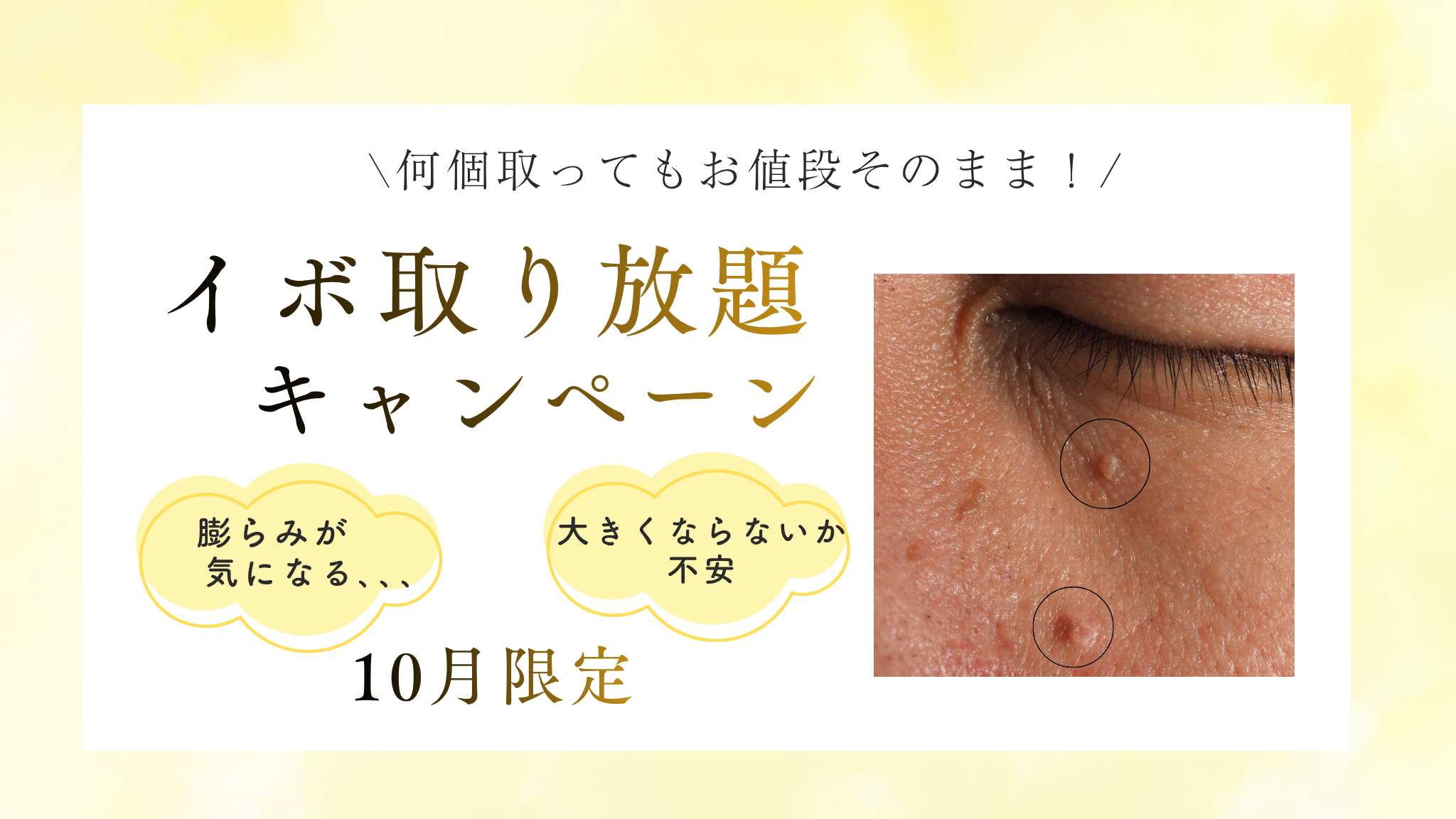 イボ取り放題キャンペーン