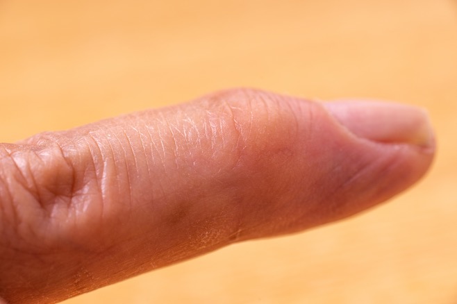 リウマチと一番間違われる指の第1関節の痛み